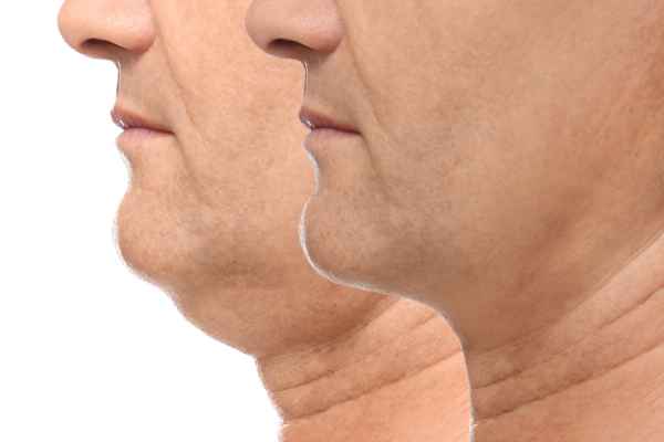 HIFU - Breakthrough in Anti - ageing 2 hifu results Hemel Hempstead