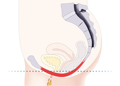 Pelvic-Floor Muscle Repair 5 Pelvic floor muscles Hemel Hempstead