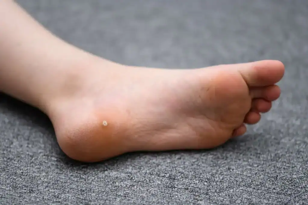 Cryotherapy For Warts And Also Verrucas 2 Image of verruca on the bottom of the foot that able to be treated with Cryotherapy Hemel Hempstead