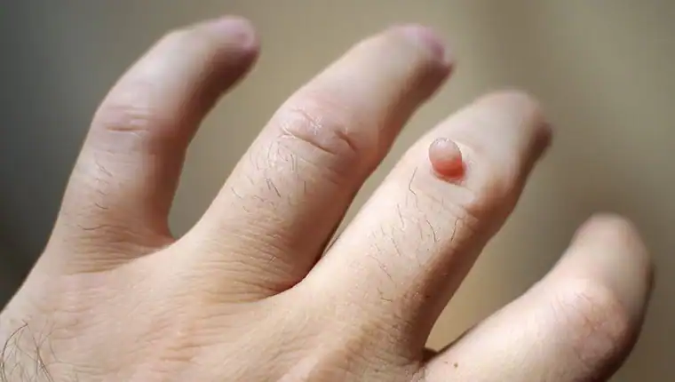 Cryotherapy For Warts And Also Verrucas 1 Image of blemish that Cryotherapy Hemel Hempstead can remove with Lipo 360.