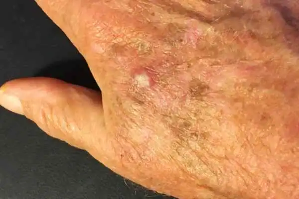 Cryopen For Actinic Keratoses 1 Image of Actinic keratoses Hemel Hempstead on a person hand