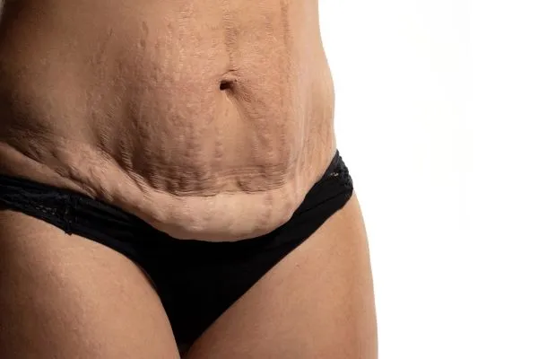 The science behind skin tightening Hemel Hempstead picture of a woman's sagging skin on the stomach